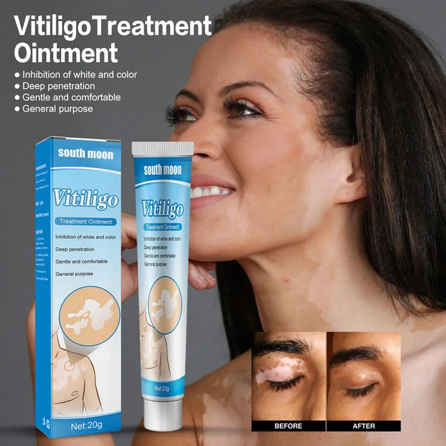 SOOTHING OINTMENT LEUKOPLAKIA Sweat Spot Healthcare Skin Vitiligo Cream SOOTHING OINTMENT LEUKOPLAKIA Sweat Spot Healthcare Skin Vitiligo Cream