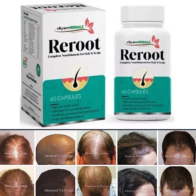 Integratore per la crescita dei capelli DHT Blocker Biotina ad alta potenza...