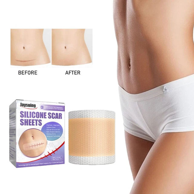 Adesivo rimozione cicatrici chirurgiche 4 cm * 1,5 m patch gel di silicone trattamento cicatrici RODE