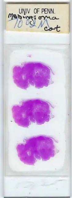 Cat Meningioma of Brain Pathology Microscope Slide