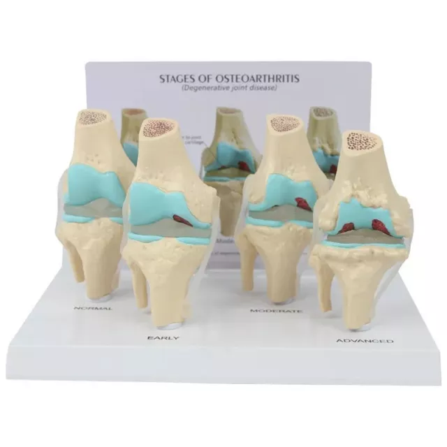 4Pcs Lesion Knee Joint Model Morbidity 4-stage Knee Joint Orthopedic Teaching