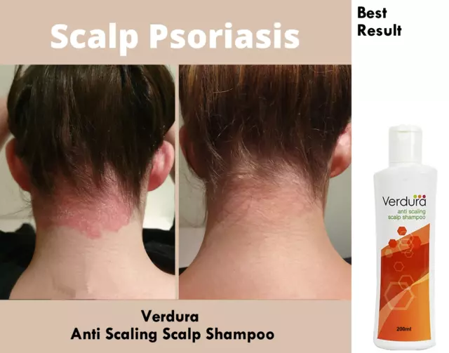 Dry Scalp Psoriasis Shampoo, Useful in Scalp Psoriasis, Shampoo 200ml