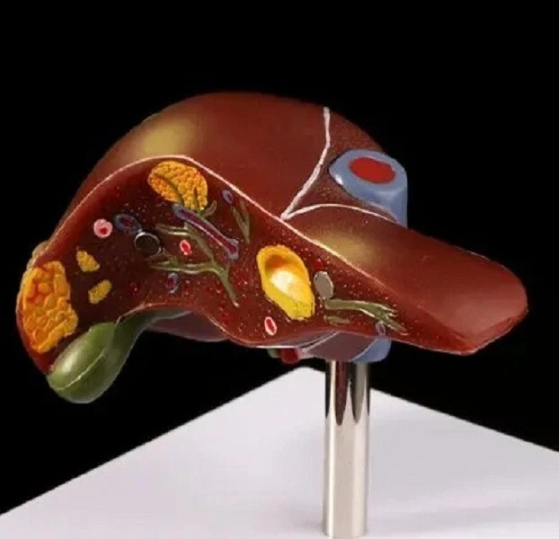 HUMAN LIVER PATHOLOGICAL Anatomical Model Anatomy Medical Teaching ...