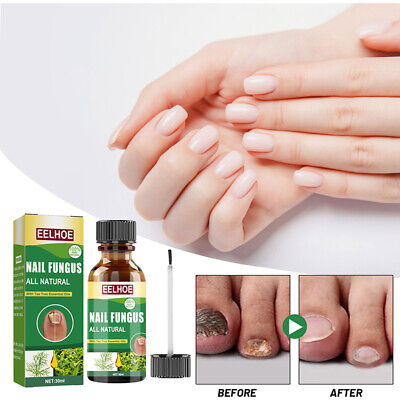 ❀ Cuidado de uñas anti hongos pie dedo cuidado de uñas reparación para matar solución
