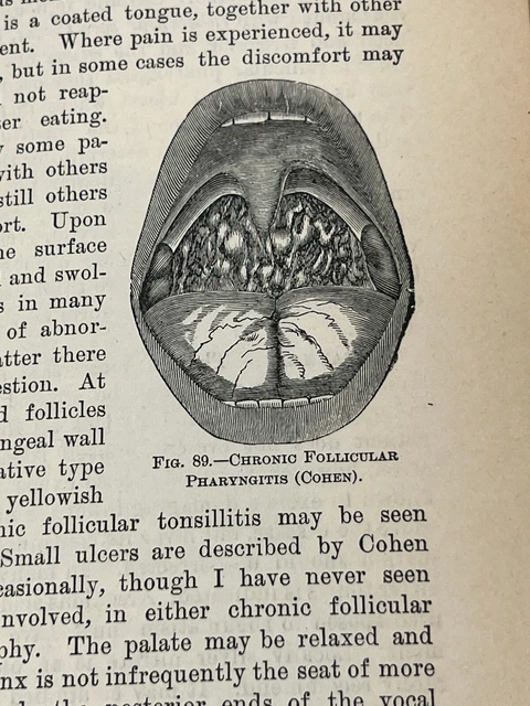 1895 Diseases Throat Chest Nose Fletcher Ingals antique medical book oddity