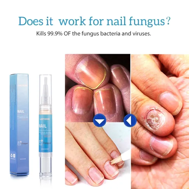Profession Advanced Fungal Nail Natural Repair Magic Nails Pen - Uk 2