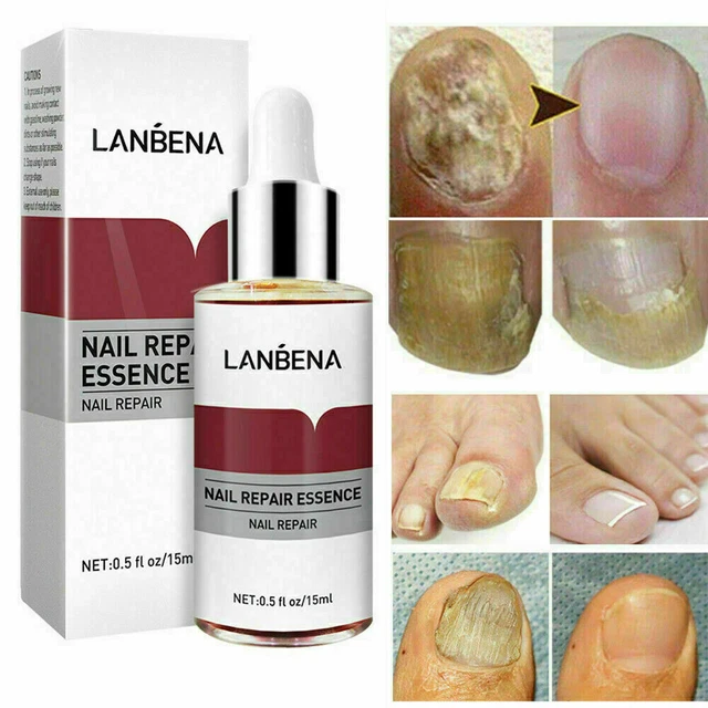 NAIL FUNGUS TREATMENT Killer Anti Fungal Infection Cure Treat Toe