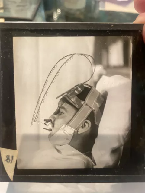 Antique Medical GLASS SLIDE Face Injury post  SURGERY Wires/Device #13 c1916