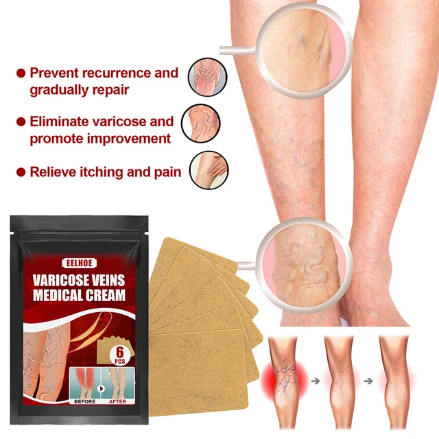 Body Vasculitis Phlebitis Spider Pain Relief Plaster Unisex Health Care Patches 4