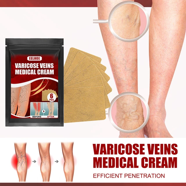 Body Vasculitis Phlebitis Spider Pain Relief Plaster Unisex Health Care Patches 8