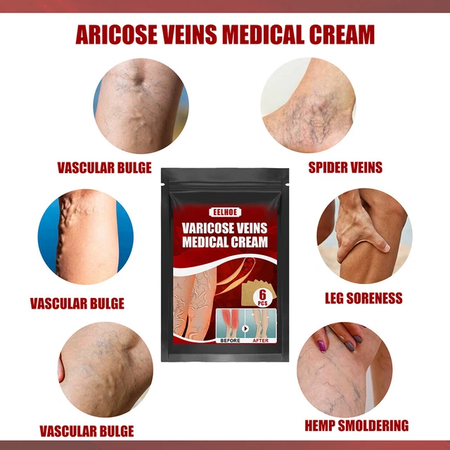 Body Vasculitis Phlebitis Spider Pain Relief Plaster Unisex Health Care Patches 9