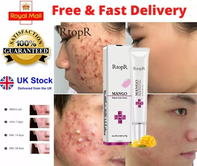 RtopR Pure Skin Anti Acne Cream Scar Blemish Stretch Mark Removal Gel Face - UK