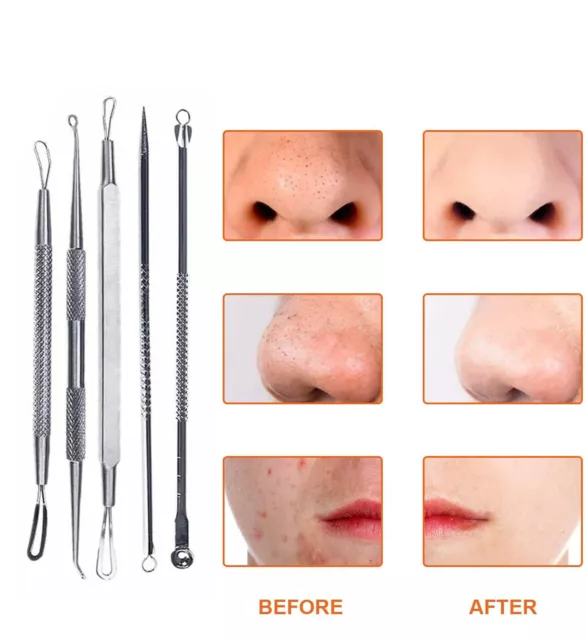 Blackhead Whitehead Pimple Comedone Spot Acne Extractor Remover Kit Popper Tools 3