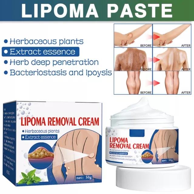 50 g Lipoma Removal Cream Skin Swelling Ointment Exfoliating Pain Relief