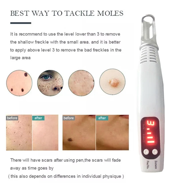 Pluma portátil para eliminación de tatuajes de picosegundos para el hogar F o lunar cicatriz oscura para el acné. Spot T2M4