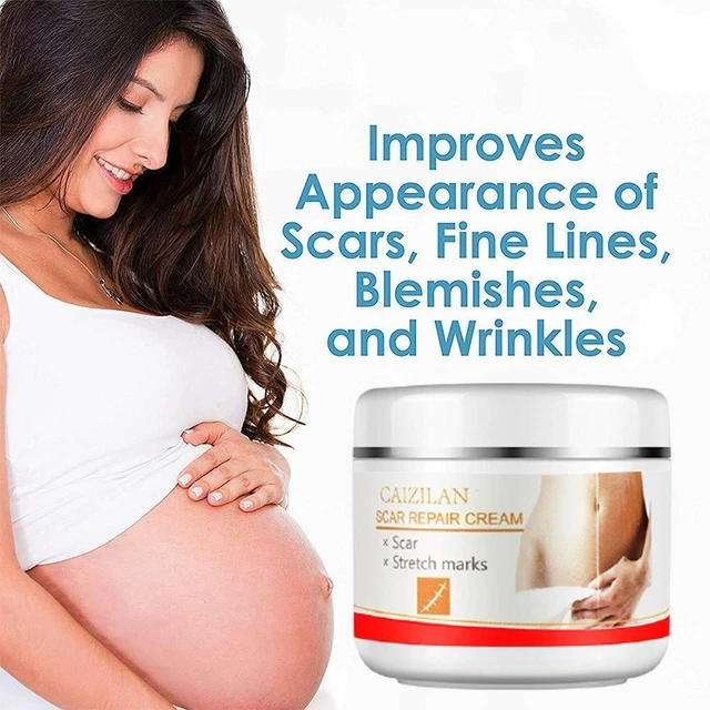 Crema levigante pelle Stretch Mark Cream per gravidanza V6E5 ed E9V9 X3G5