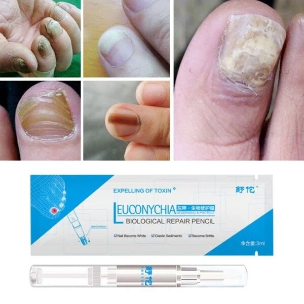 NAIL FUNGUS TREATMENT Pen Anti Fungal Nail Infection Treatment 3ml