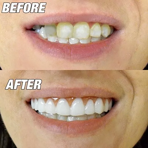 Instant Smile Confort Ajustable Flexible Dientes Top Cosmético Revestido Talla