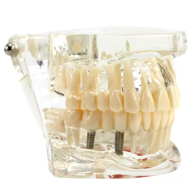 Dental Study Teach Implant Teeth Model Restoration Bridge Caries Education