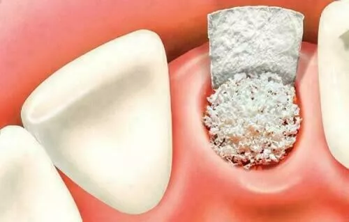 Paquete de 4 Sustituto de injerto óseo biocompatible sintético B-OSTIN 0,5 CC