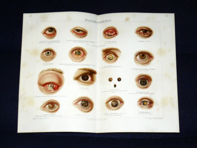 Augenkrankheiten Lithographie von 1893 – 127 Jahre ORIGINAL + Text