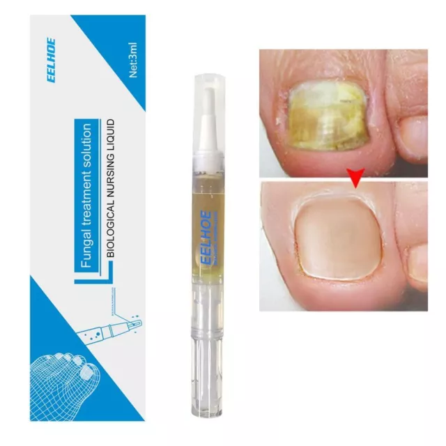 Toe Nail Fungus Treatment Extra Strength for Fingernail & Toe Anti-Fun