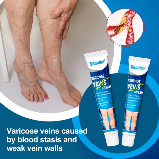 Varicose Veins Treatment Cream Vasculitis Phlebitis Spider Cream Removal Plas-tz