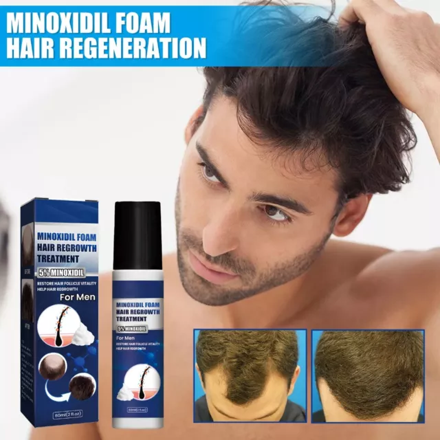 5% Minoxidil Biotin Extra Stark Haarwachstum Schaum Gegen Haarausfall Für Herren
