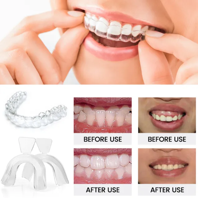 4 PIEZAS Corrector de dientes de ortodoncia dental para adultos Retenedor Herramienta de enderezamiento Reino Unido