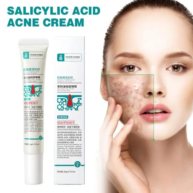 Salicylic Acid Acne Marks Fade Cream Tea Tree Oil Gentle Cream K5D2 F0H3