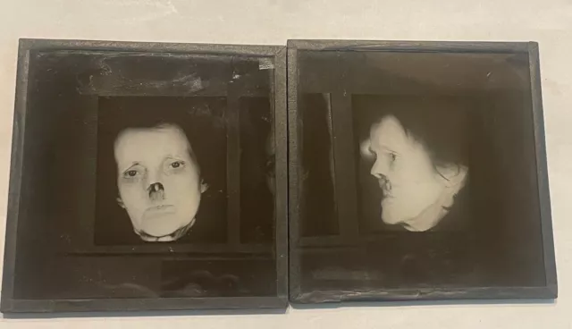 lot 2 Antique Medical GLASS SLIDE Face Injury prior SURGERY #14 c1916