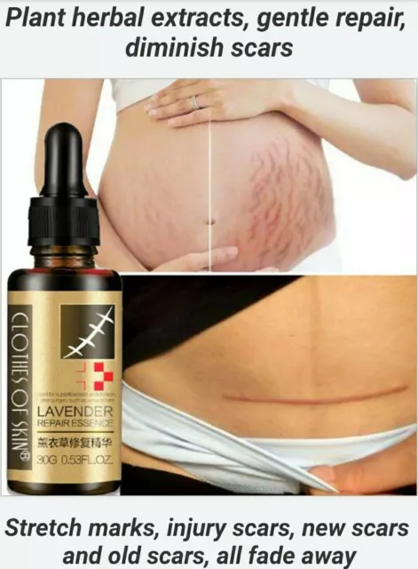 Stretch Marks Serum, Injury scars, new scars, old scars, all fade away