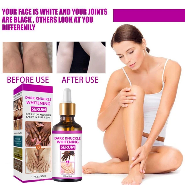 Aceite de terapia de acantosis nigricans, aceite corrector de manchas oscuras 50 ml