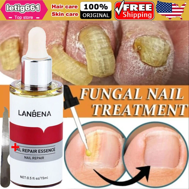 FUNGAL NAIL REPAIR Treatment Essence Serum Anti Fungus Removal + Nail