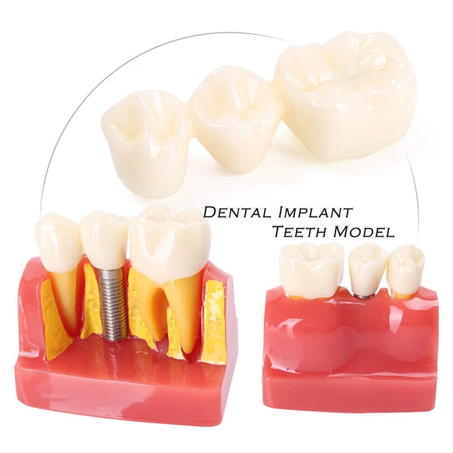 1 PC Dental Implant Analysis Crown Bridge Demonstration Teeth Model Removable