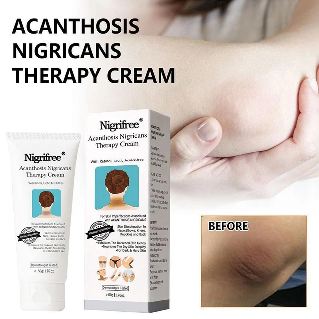 ACANTHOSIS NIGRICANS TREATMENT Oil Black Spine Skin For Underarm