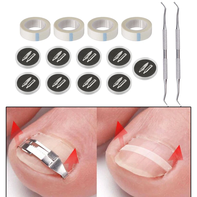 INGROWN TOENAIL CORRECTOR Paronychia Treatment Pedicure Recover Foot
