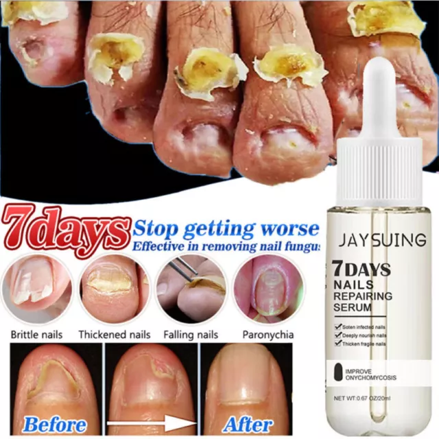 Anti Fungal Nail Treatment fungu Nail Finger Toe Fungus Onychomycosis  Remover- | eBay