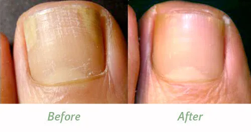 NEW Fungal treatment lotion kills 99.9% skin & nail fungus & toes Evterpa , 50ml
