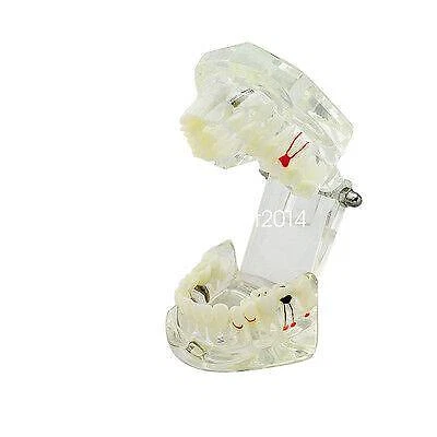 Full Mouth Dental Implant Model for Optimal Oral Health and Restoration