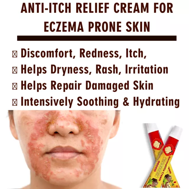 Eczema Dermatitis Psoriasis Skin Cream Ointment Treatment Anti-itching