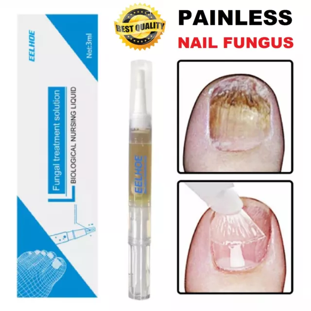 Anti Fungal Nail Treatment Finger Toe Fungus Repair Care Treatment Liquid Pen