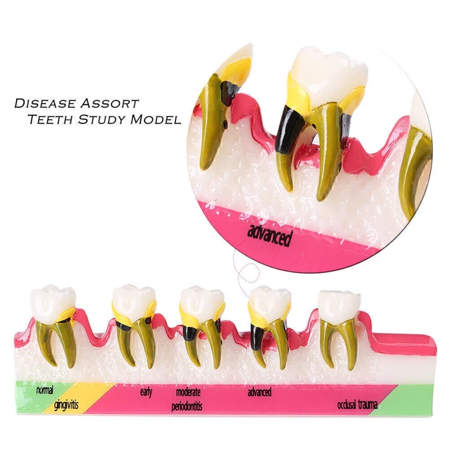 1x Dental Lab Study Teach Model Periodontal Disease Assort Teeth Display Dental