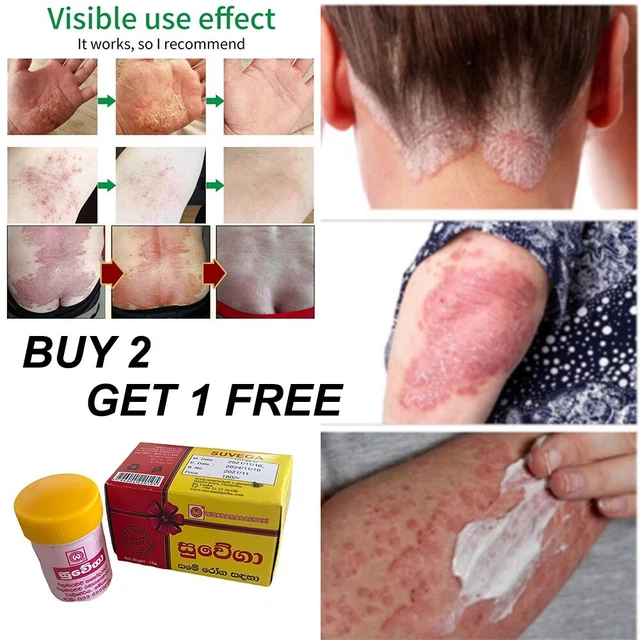 TINEA VERSICOLOR ECZEMA Antifungal Ringworm Pityriasis Private Ich