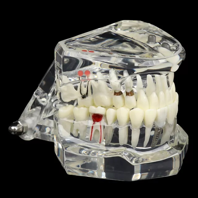 Dental Model Teeth Implant Restoration Bridge Teaching for Study Tooth~