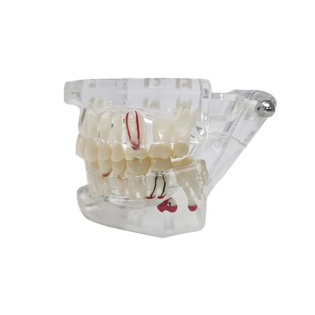 Dental Transparent Model Display Planting Nail Teaching Practice Medical Patient