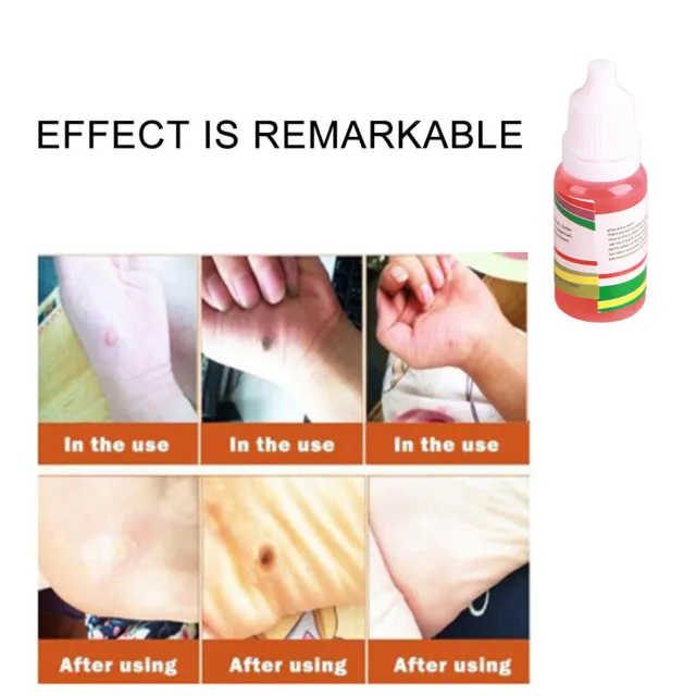 10ml Skin Tag Remover Skin Tag Mole And Genital Wart Remover Fluid