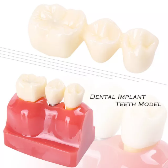 1 × Dental Equipment Implantat Analyse Krone Brücke Demonstration Zähne Modell