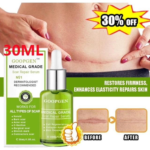 Siero anticicatrici avanzato riparazione cicatrici siero essenza levigante 30 ml-20%