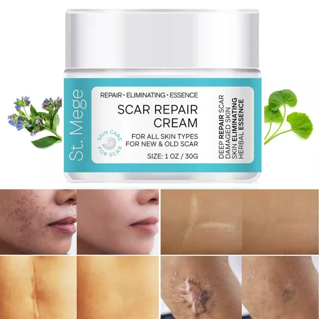 Scar Removal Cream for New & Old Scar, Stretch Marks Relief and Burns Repair